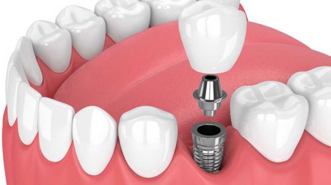 Implantologia Dentale Per Dente Singolo O Ponte Su Impianti